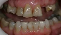 woman's upper and lower teeth showing missing teeth before getting partial dentures from dentist Adelaide, SA Cumberland Park