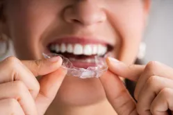 How Does Invisalign Treatment Work