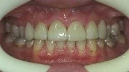 close up of woman's mouth showing teeth after new dental veneers Cumberland Park, SA dentist