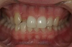 crooked tooth fixed with 6 month Braces in Adelaide