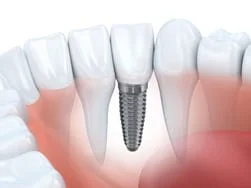 illustration of teeth and gums with dental implant embedded, dental implants Peachtree City, GA
