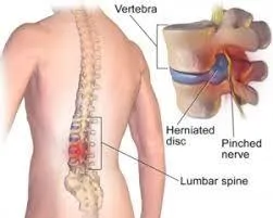 Spinal Decompression Therapy