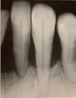 moderate periodontitis radiograph