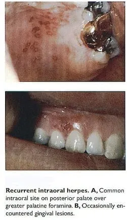 Cold sores/herpes can occur in the mouth too