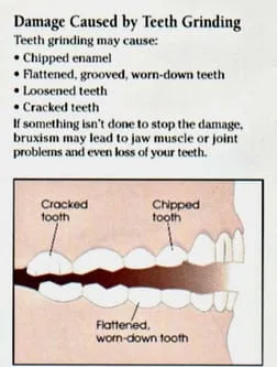 Grinding damages teeth