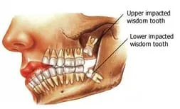 illustrated diagram of face showing internal wisdom teeth impacted