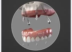 dental implants wiltons minors FL