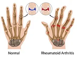 Normal vs rheumatoid arthritis in hands