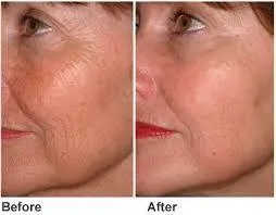 HIFU FaceLift Wrinkle Removal