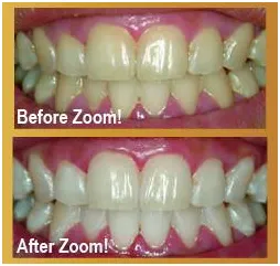 patient's teeth before and after results with Zoom! teeth whitening Newark, CA dentist