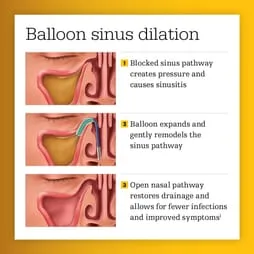 balloon sinus