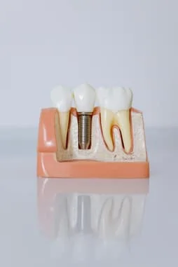 Photo by cottonbro studio: https://www.pexels.com/photo/close-up-shot-of-dental-implant-model-6502306/