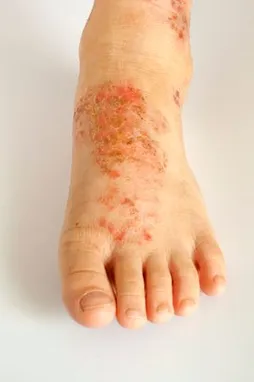 skin diseases on feet