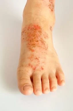 skin conditions