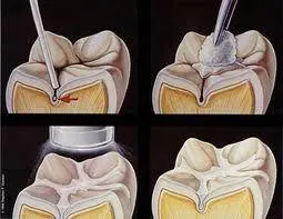 How sealants are applied on the teeth