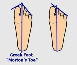 Mortons Toe Greek Foot