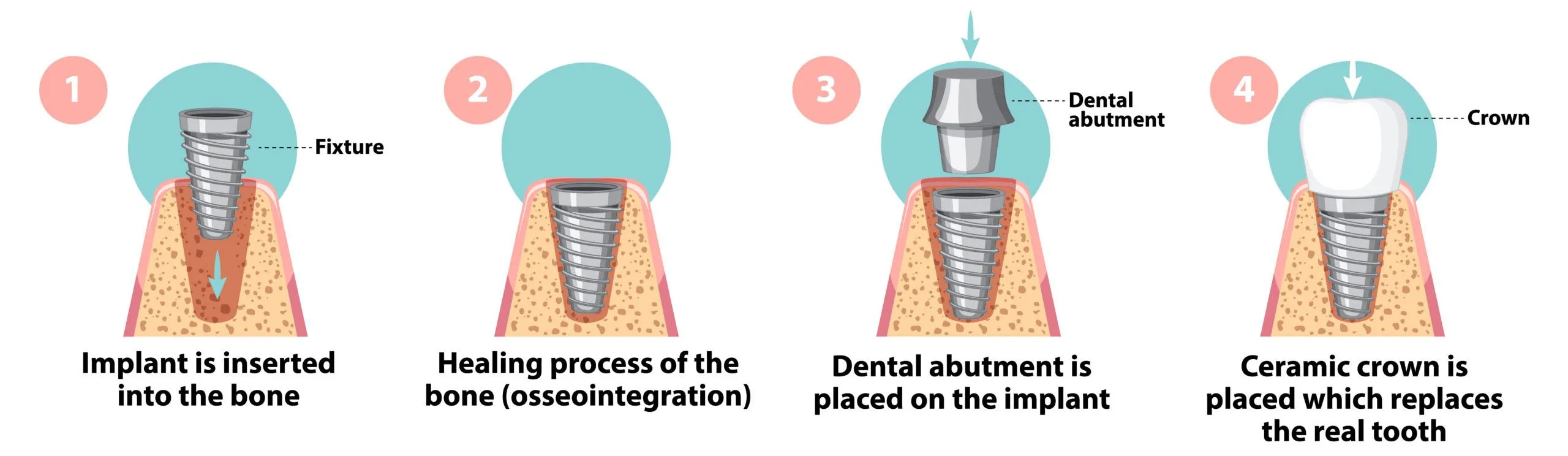 Dental implants Rochester Hills | Birmingham MI