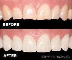 before and after image of chipped misshapen teeth, then corrected with dental veneers Boulder, CO cosmetic dentistry