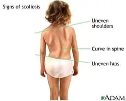 scoliosis_signs.jpg