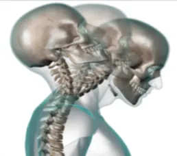 CUPERTINO Chiropractor | CUPERTINO chiropractic Whiplash Injury | CA |