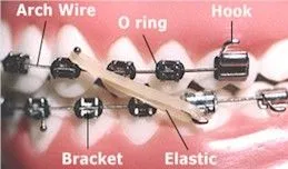 Orthodontic Terms