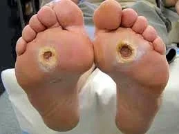 The sugar affects the nerves of the feet
