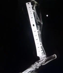 xray of leg with metal splint