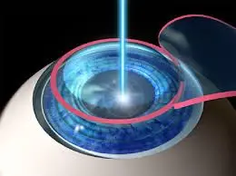 Lasik2.jpg