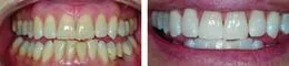 before and after zoom whitening