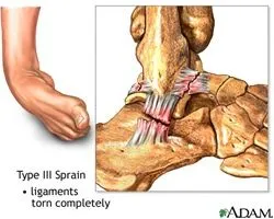 Ankle Sprain or Ligament Injury - Bunbury Foot & Ankle Surgeon