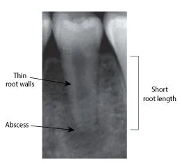 Regenerative Procedure - Pre-op