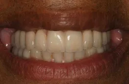 Step 2 Ten implants on the upper jaw for a beautiful new implant smile. Additional crowns were done on the lower posterior teeth.