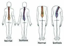 scoliosis diagram