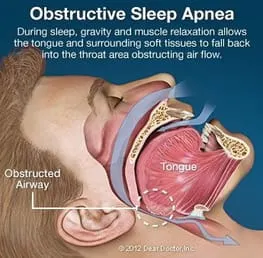 illustration showing man's head and obstructed airway in throat, obstructive sleep apnea Washington, DC