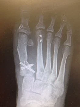 Bunion X-Ray After Surgery
