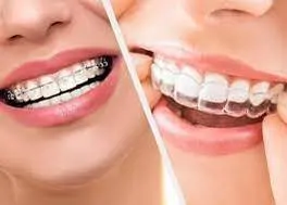side by side image of woman's mouth with clear braces next to woman's mouth wearing clear aligners, Orthodontics Milford, MI
