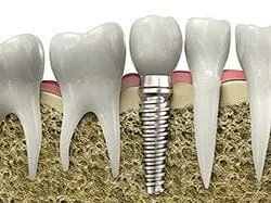 model of teeth and embedded dental implants Selmer, TN family dentist