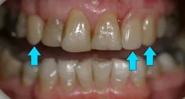 woman's teeth close up, showing partial dentures Cumberland Park, SA dentist