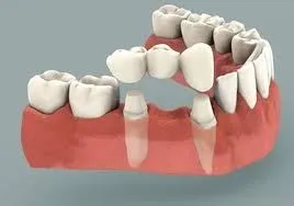 illustration of teeth in lower jaw with a 3 unit bridge replacing a missing tooth, Dental Bridges Melrose, MA dentist