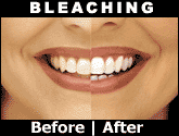 before and after image of teeth bleaching, teeth whitening Decatur, IL cosmetic dentistry