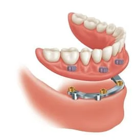 Dental Implants Stockton