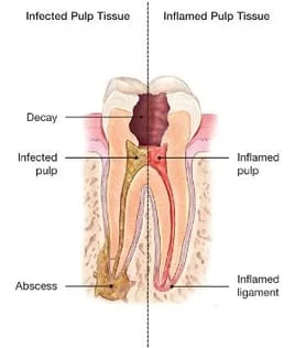 Abscessed Tooth Explained