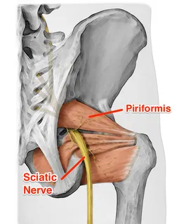 Piriformis Syndrome - Symptoms, Causes & Treatment