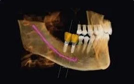 CBCT scanner