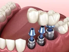 illustration showing mouth with dental implants replacing multiple teeth, implant dentistry Salem, OR
