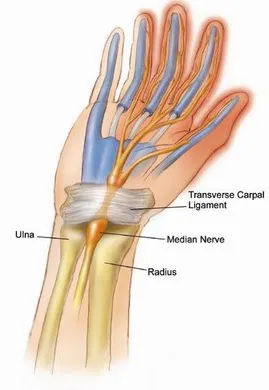 Carpal Tunnel Syndrome NYC Carpal Tunnel Treatment NYC