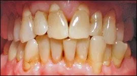 Before image of patient's teeth