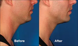 Kybella Before and After Treatment Photo