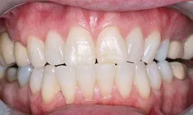 Cedar Rapids Tooth Whitening Example 1