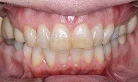 Cedar Rapids Tooth Whitening Example 1